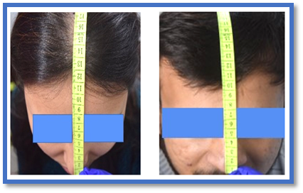 Hair Length Measurement Using Calibrated Tools