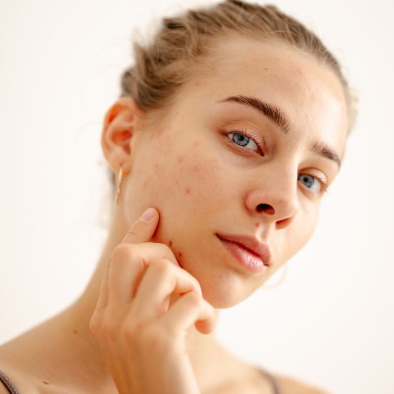 Femme avec acné touchant son visage.