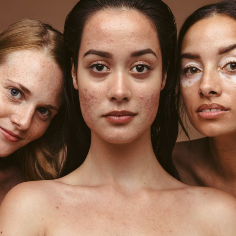 Trois femmes montrant diverses conditions de peau.