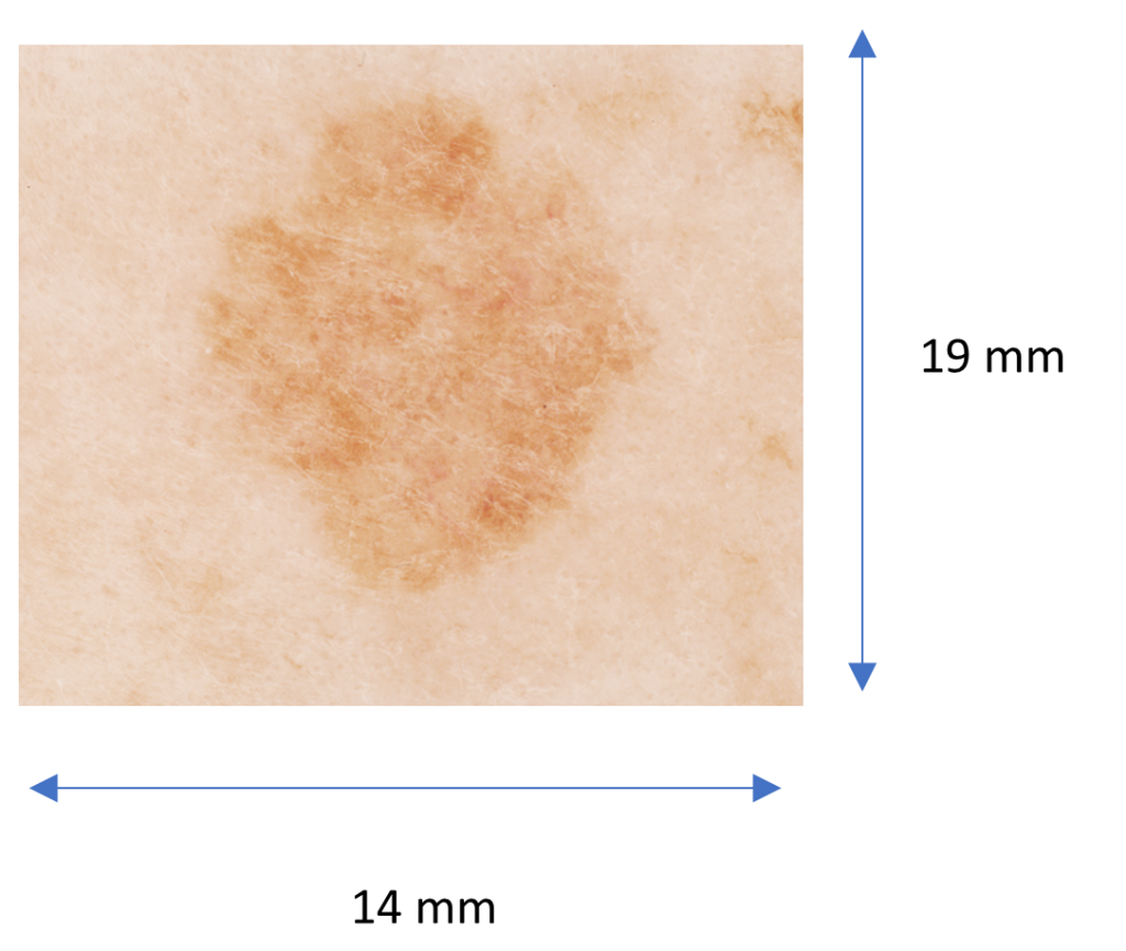 Tache cutanée brune de 19 mm sur peau.