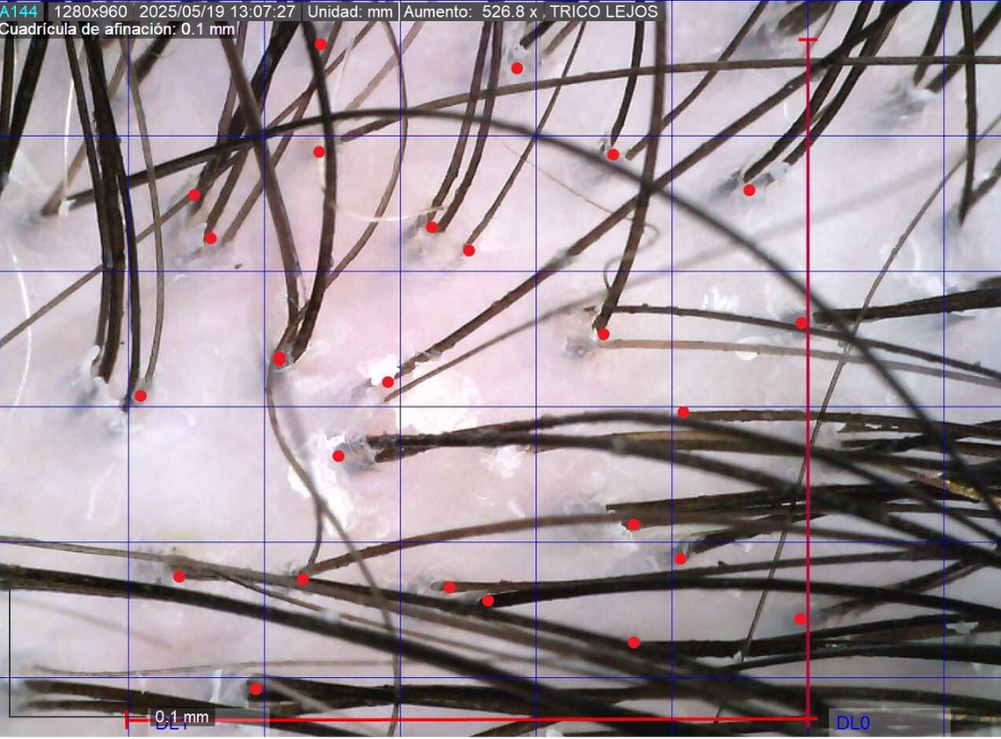 Microscopie du cuir chevelu avec follicules pileux