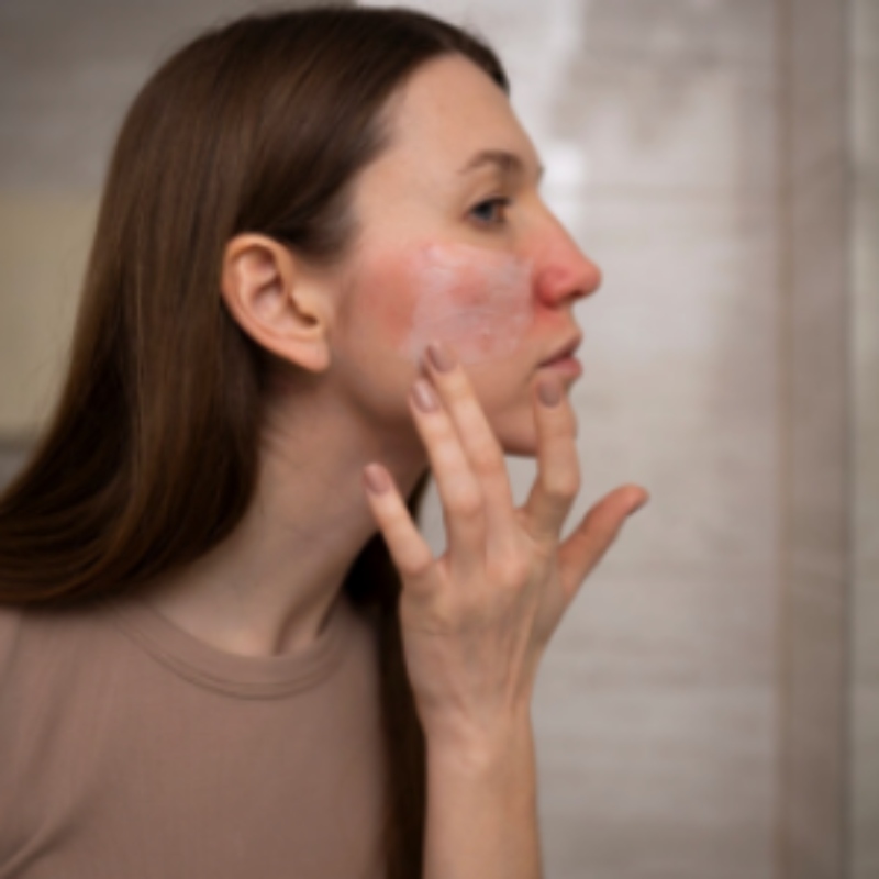 Femme appliquant crème sur visage rougi.